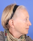 Before Hair Transplant&nbsp;Hair Thinning